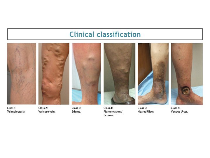 Symptoms of Vein Disease CEAP Classification