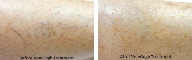 Spider Vein Before and After Treatment Photos